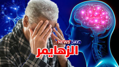 الزهايمر