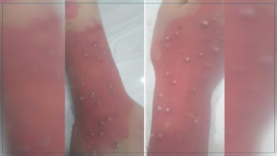 صفاقس :الاشتباه في اصابة مريضة بجدري القردة... رئيس قسم الأمراض السارية يوضح جدري القردة