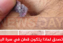 قطن في سرة البطن