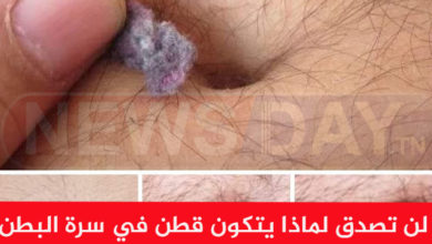 قطن في سرة البطن